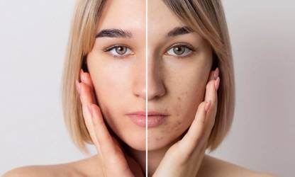 აკნეს მკურნალობა - მიზანმიმართული პრობლემური კანის ზრუნვა